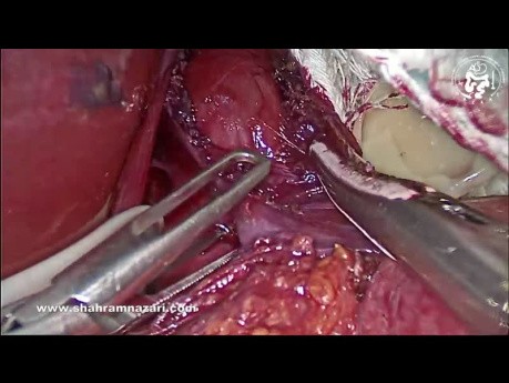 Angemessene Heller-Myotomie