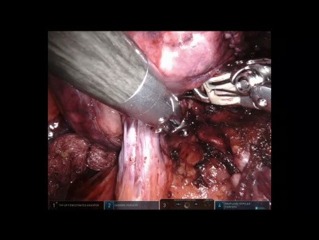Operation zur anatomischen Entfernung eines Lungensegments.