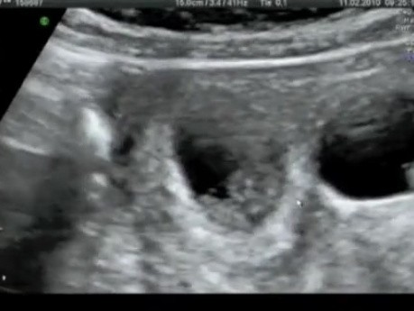  Transvaginale fetale Reduktion