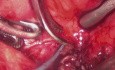 Laparoskopische Blasenhalsrekonstruktion unter Verwendung eines bukkalen Schleimhauttransplantats