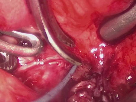 Laparoskopische Blasenhalsrekonstruktion unter Verwendung eines bukkalen Schleimhauttransplantats