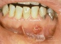 Zahnwurzelabszess und Granulom