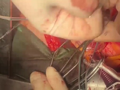 Wie führt man einen Mitralklappenersatz bei einem Patienten mit Stenose und Mitralklappeninsuffizienz durch?
