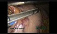 Laparoskopische/ thorakoskopische Ösophagektomie 
