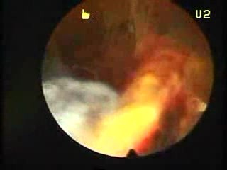 Trophoblastische Retention
