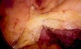 Laparoskopische Sigmaresektion mit Patch-Resektion der Vena cava bei T4-Sigmakarzinom