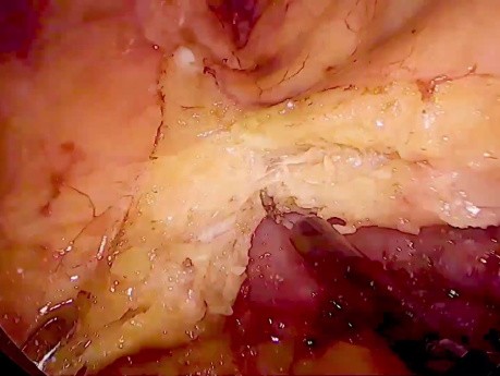 Laparoskopische Sigmaresektion mit Patch-Resektion der Vena cava bei T4-Sigmakarzinom