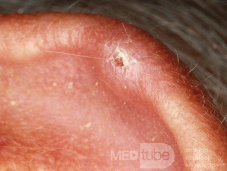 Chondrodermatitis nodularis helicis chronica Winkler