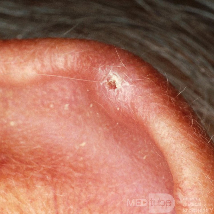 Chondrodermatitis nodularis helicis chronica Winkler