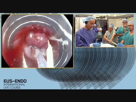 Endoskopische Resektion - Diskussion: ESD oder CAP EMR?