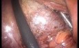 Laparo-endoskopische Single-Site-Cholezystektomie (LESS) mit begleitender suprazervikaler Hysterektomie ohne Vollnarkose