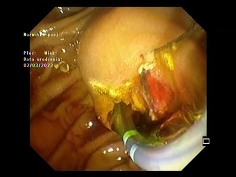 Papillärer Tumor 