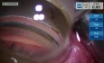 Glaukom-Mikrostent-Implantat im oberen Quadranten