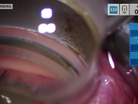 Glaukom-Mikrostent-Implantat im oberen Quadranten