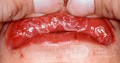 Syphilis [sekundäre Schleimflecken der Lippe]