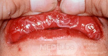 Syphilis [sekundäre Schleimflecken der Lippe]