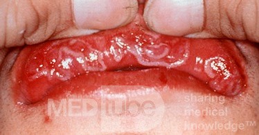 Syphilis [sekundäre Schleimflecken der Lippe]
