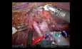 Titel Robotergestützte erweiterte Hepatektomie links und Gallenrekonstruktion bei Klatskin-Tumoren