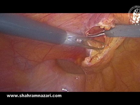 Respektiere die Schicht: Erhalt der Fascia transversalis bei der TAPP-Hernienreparation