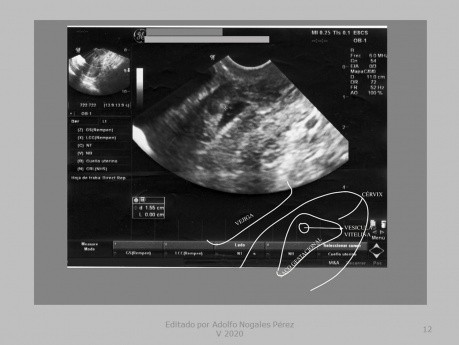 Eileiterschwangerschaft - Narbe nach Kaiserschnitt