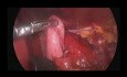 Fundoplication und Myotomie nach Heller 