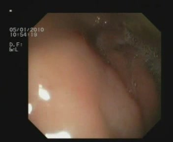 Fistel des Bulbus duodeni – eine Komplikation einer Magengeschwürerkrankung