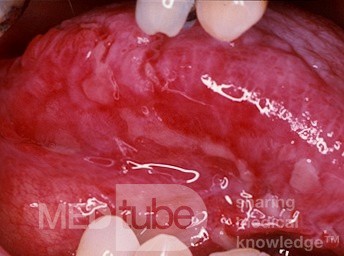Erosiver Lichen planus