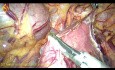 Gastrointestinaler Stromatumor im dritten Teil des Duodenums