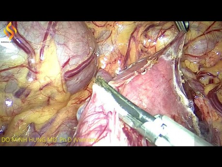 Gastrointestinaler Stromatumor im dritten Teil des Duodenums