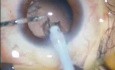 Phakoemulsifikation - Kataraktoperation