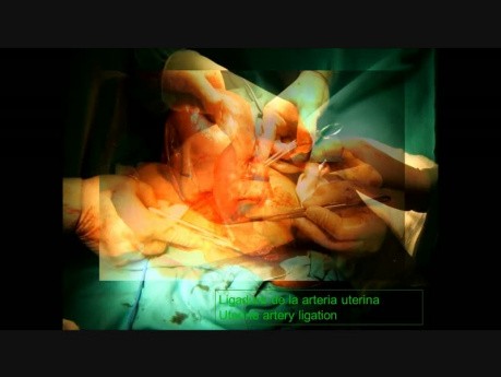 Unterbindung der Uterusarterie beim Kaiserschnitt