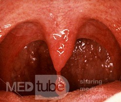 Gutartiges Papillom der Uvula