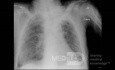 COVID-19- Röntgen-Thorax (3)