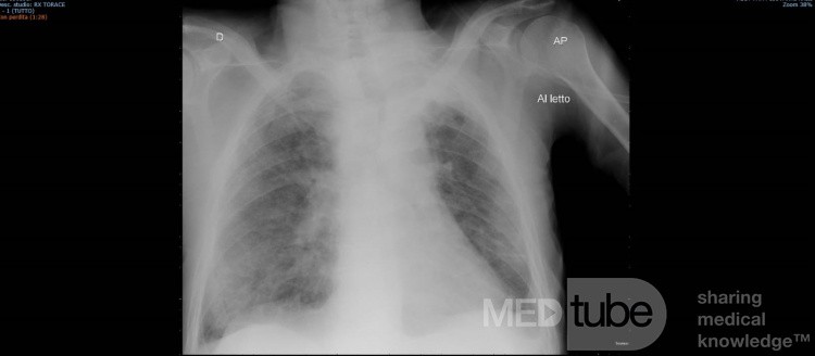 COVID-19- Röntgen-Thorax (3)