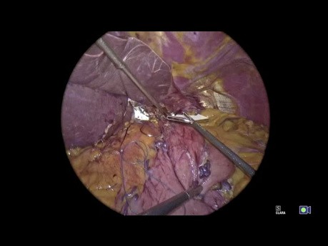Geometry Fundoplication App Tutorial