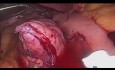 Ein Anastomose-Magenbypass