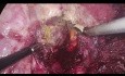 Thorakoskopische Leberteilresektion bei Läsionen im Segment 7