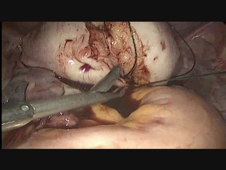 Gut vaskularisiertes Uterusmyom (8,6 x 7 cm)