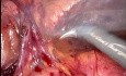 Bilateral Robotic inguinal hernia TAPP