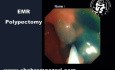 Endoskopische Mukosaresektion (EMR) bei der Behandlung von kolorektalen Polypen