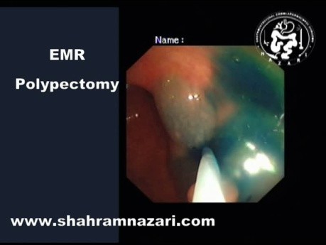 Endoskopische Mukosaresektion (EMR) bei der Behandlung von kolorektalen Polypen