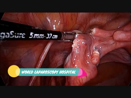 Laparoskopische Hysterektomie mit  einem infrarotem Harnleiterstent