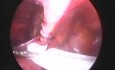 Laparoskopische Reparatur der Leistenhernia