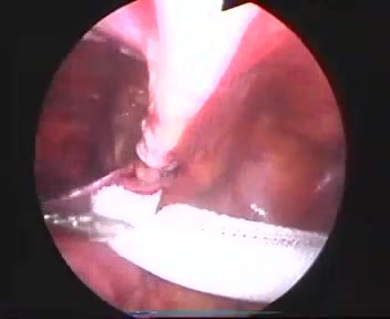 Laparoskopische Reparatur der Leistenhernia