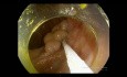 Endoskopische Submukosadissektion (ESD) von Adenom des Aszites - unbearbeiteter Film aus der Operation