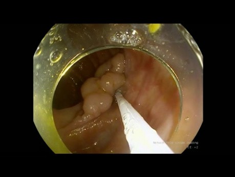 Endoskopische Submukosadissektion (ESD) von Adenom des Aszites - unbearbeiteter Film aus der Operation