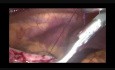 Laparoskopische intragastrische Chirurgie (LIGS) – Mein operatives Vorgehen Schritt für Schritt