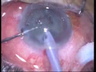 Phakoemulsifikation – Horizontales Schneiden