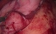Blutstillung während der Sleeve-Gastrektomie