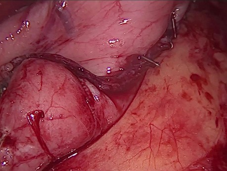 Blutstillung während der Sleeve-Gastrektomie